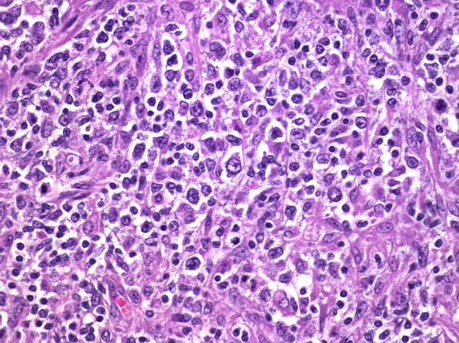 Diagnostic Guidelines Don’t Catch All Rare Cancers, Study Finds