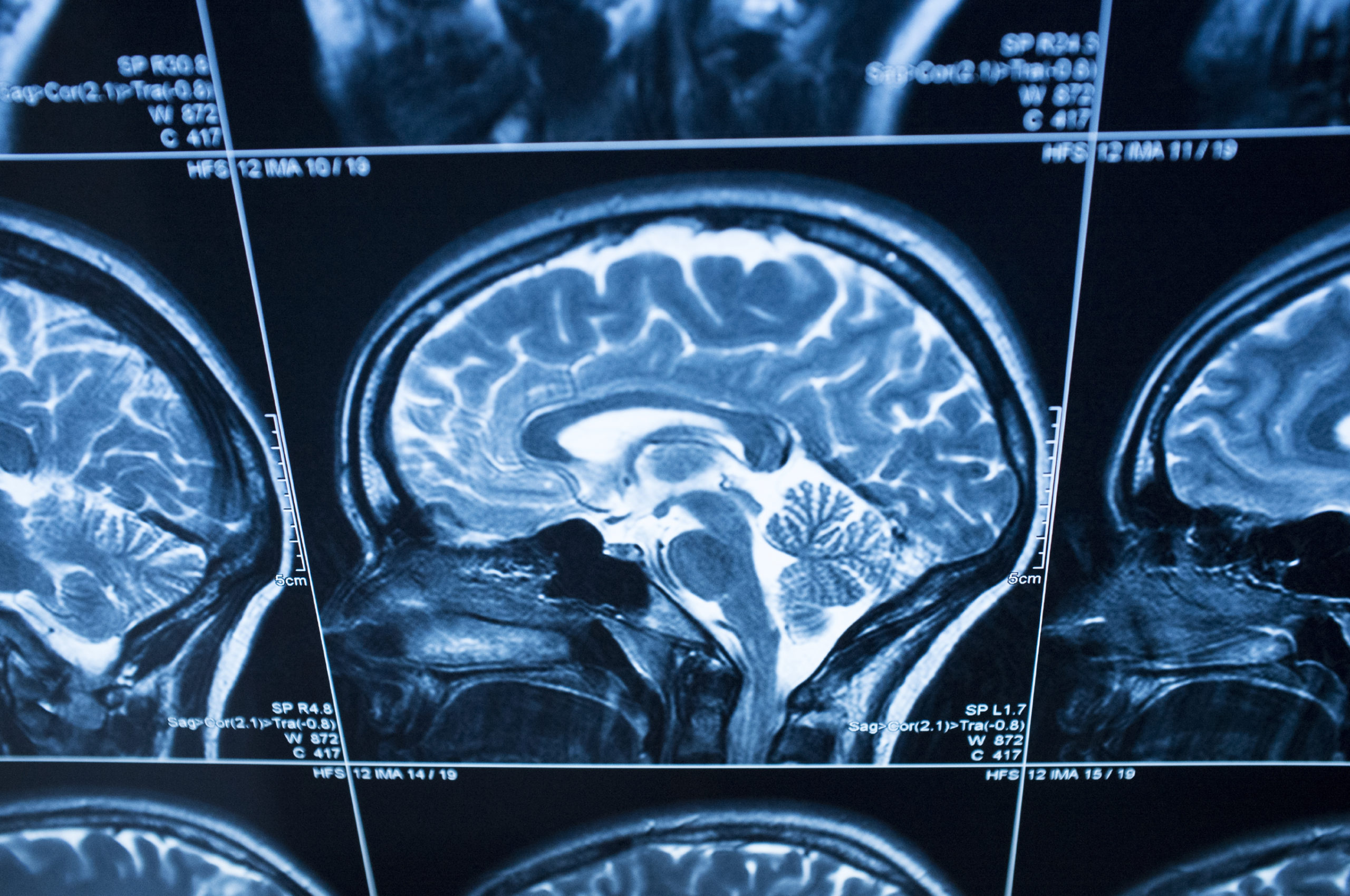 Experimental Drug May Slow Childhood Brain Tumors 