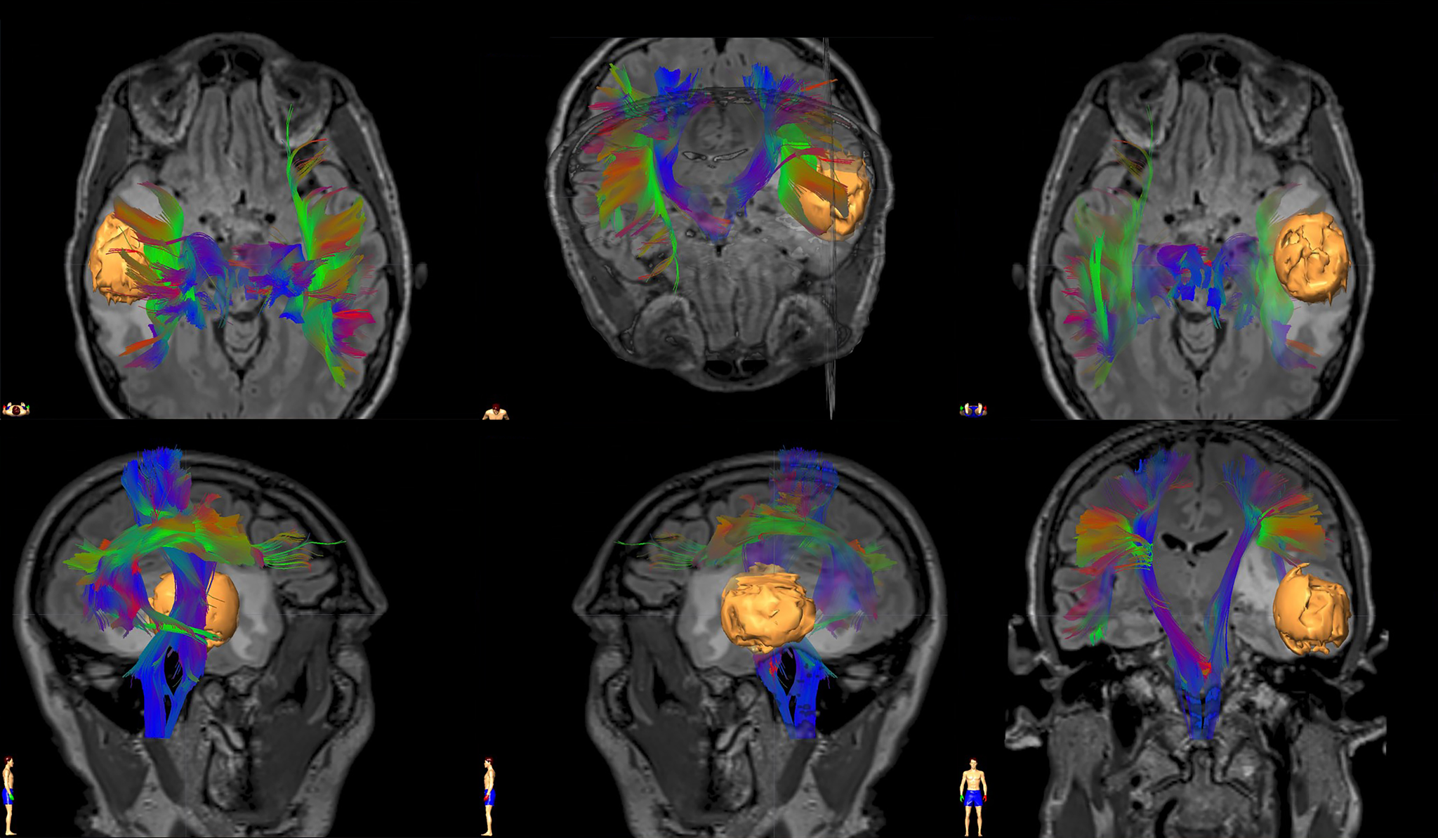 New 3D Spatial Approach Reveals Interactive View of Glioblastoma and Therapeutic Targets