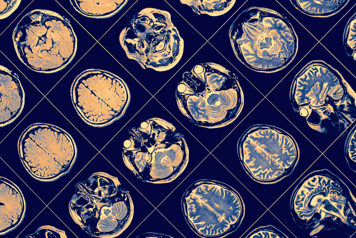 Combination Therapy Does Not Extend Survival in Glioblastoma