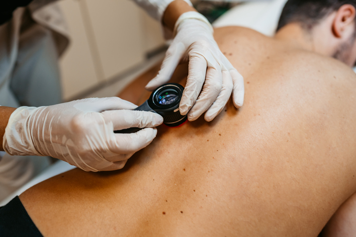 Treating Skin Cancer Without Risking Transplanted Kidneys in Organ Recipients