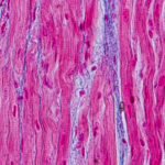 Exploring the Link Between Inflammation and Heart Disease