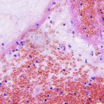 Study Establishes Cell Death as a Driving Force in Glioblastoma