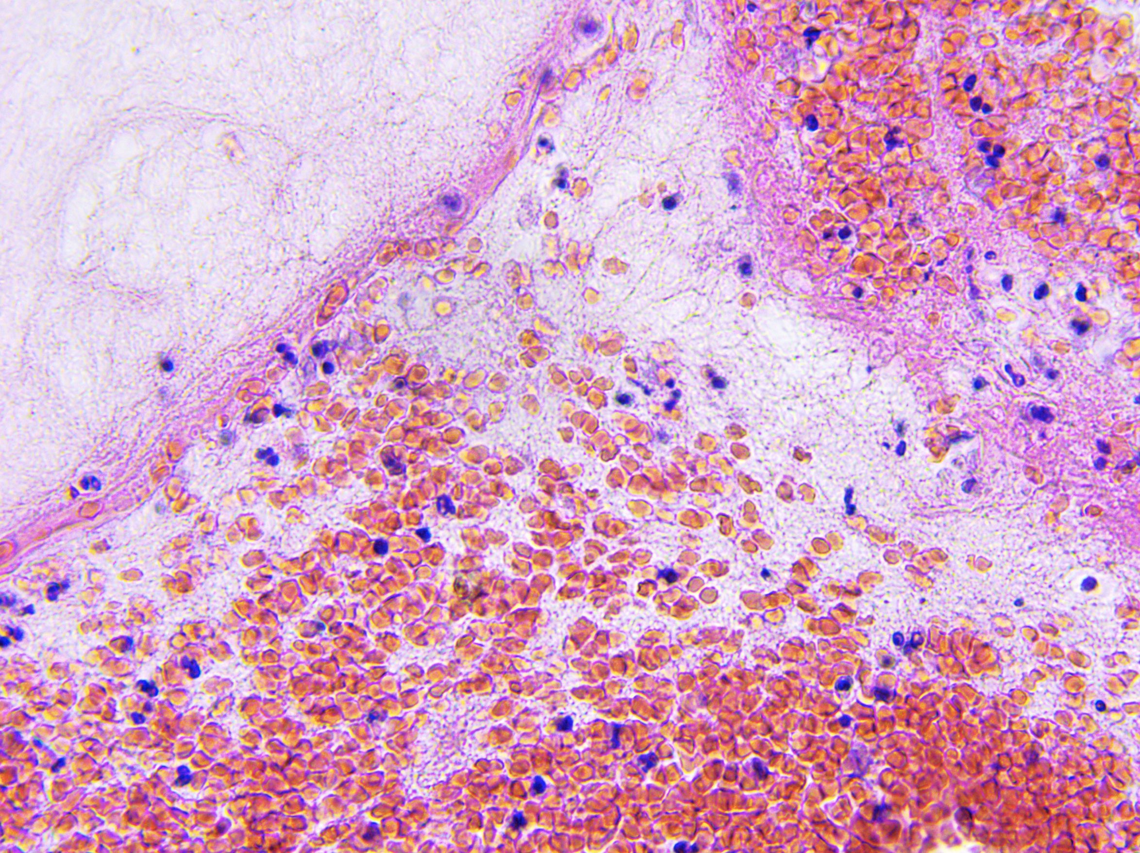 Study Establishes Cell Death as a Driving Force in Glioblastoma